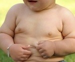 140,000 children are so obese that if they were adults, they would immediately be eligible for surgery