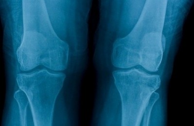 Vitamin D has been linked to bone health