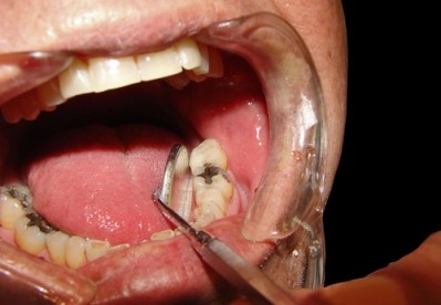 Tooth decay is one of the most widespread health problems